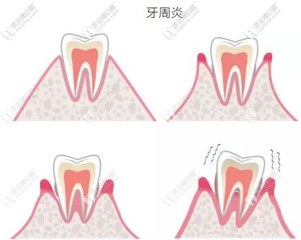 牙周炎