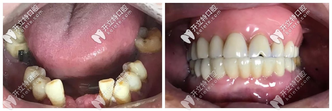 无挂钩镶牙是怎么回事?分享无挂钩假牙的安装视频和价格