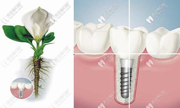 石家庄中诺口腔种植牙价格