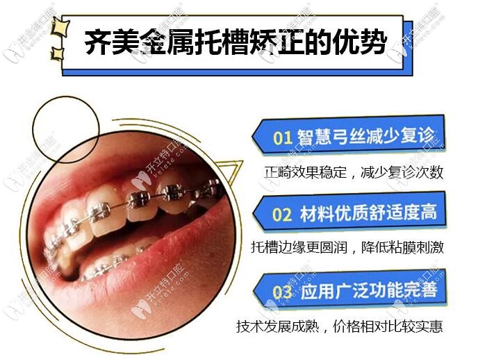 齐美口腔金属托槽矫正优势