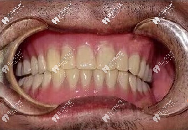 70岁无牙老人做全口种植牙真实感受：立得用种植牙技术靠谱