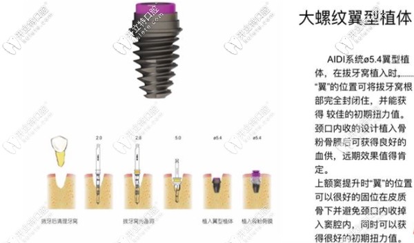 aidi属大螺纹翼型植体