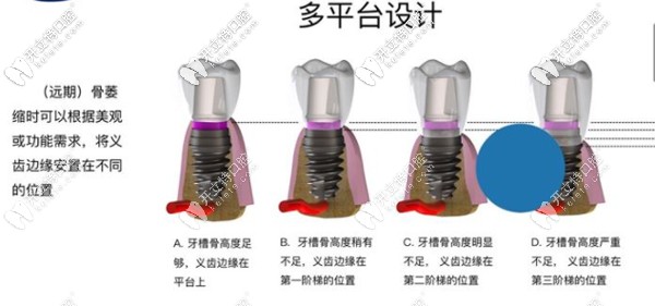 AIDI植体的设计独特