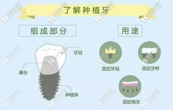 种植牙的组成部分