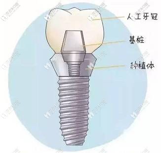 种植体的组成部分