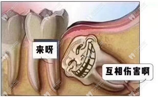 侵犯邻牙（紧跟牙）：容易引起牙周炎