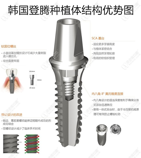 在曙光电子做韩国登腾进口种植体信息