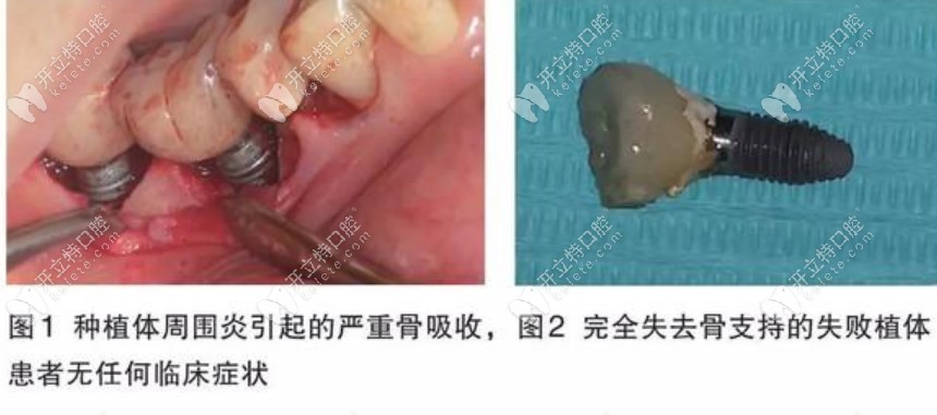 沒有壞也要拔掉再做種植牙嗎?