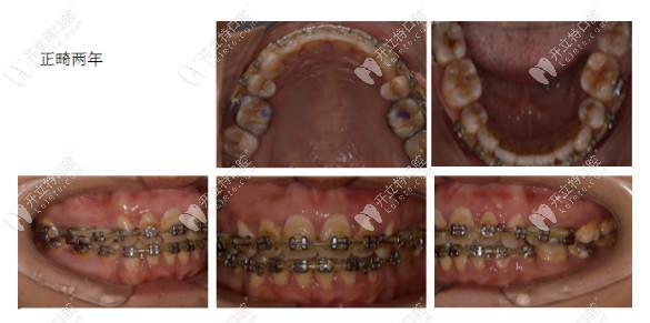 维乐口腔做金属固定矫正两年时间结束
