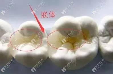 嵌体修复牙齿的症状