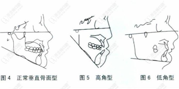 下颌平面角高角