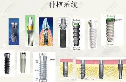 进口种植牙种类齐全，临床使用时间长